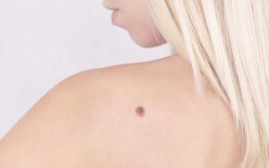 Melanoma és Bőrdaganat Központ